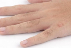 Kenali Tanda Lahir Cokelat pada Anak, Bisa Jadi Gejala Neurofibromatosis Tipe 1