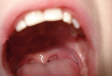 Waspada Infeksi Sekitar Gigi Tanda Adanya Kanker Mulut